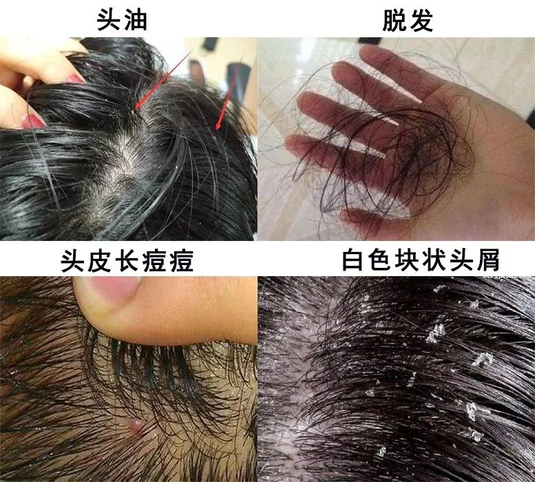 头上的螨虫用什么方法消除,头上又油又痒