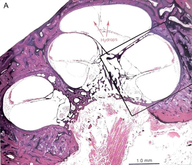 22张图，细说梅尼埃病的组织病理学特点丨“晕”筹帷幄