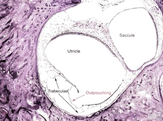 梅尼埃病深度解析,梅尼埃病病理解剖