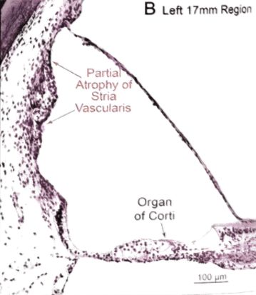 22张图，细说梅尼埃病的组织病理学特点丨“晕”筹帷幄