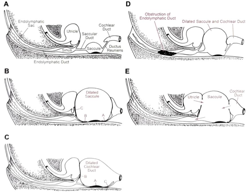 22张图，细说梅尼埃病的组织病理学特点丨“晕”筹帷幄
