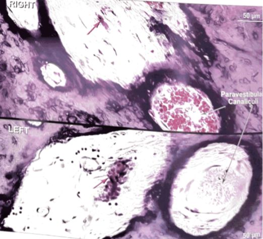 22张图，细说梅尼埃病的组织病理学特点丨“晕”筹帷幄