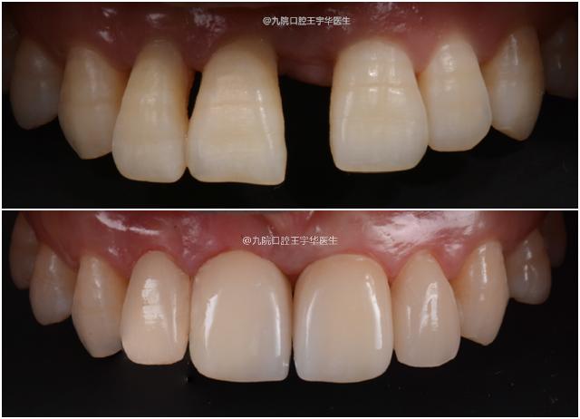 门牙中间有缝是否影响运势,门牙开缝是不是很丑