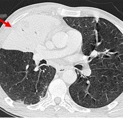 肺炎克雷伯化脓性脑膜炎,肺炎克雷伯菌的研究动态
