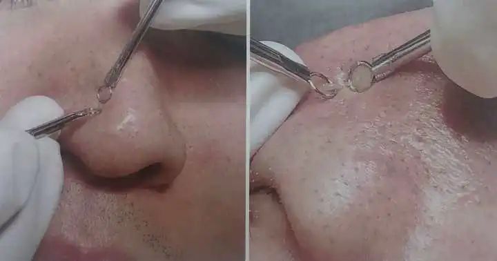 去除鼻子黑头视频大全,如何去除鼻子上的黑头12岁孩子