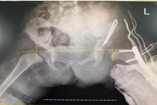 湖南省儿童医院先天性髋关节脱位,幼儿髋关节脱位切开复位和断骨