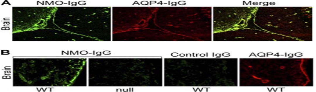 张星虎视神经脊髓炎,张星虎多发性硬化