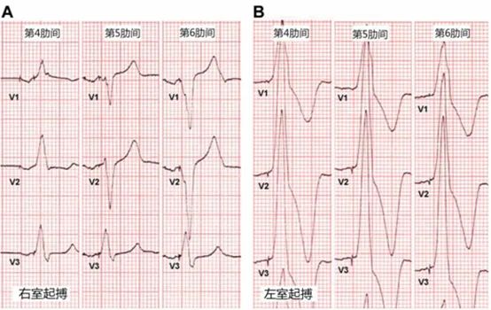 心电图显示心室起搏,心电图电极v4位置