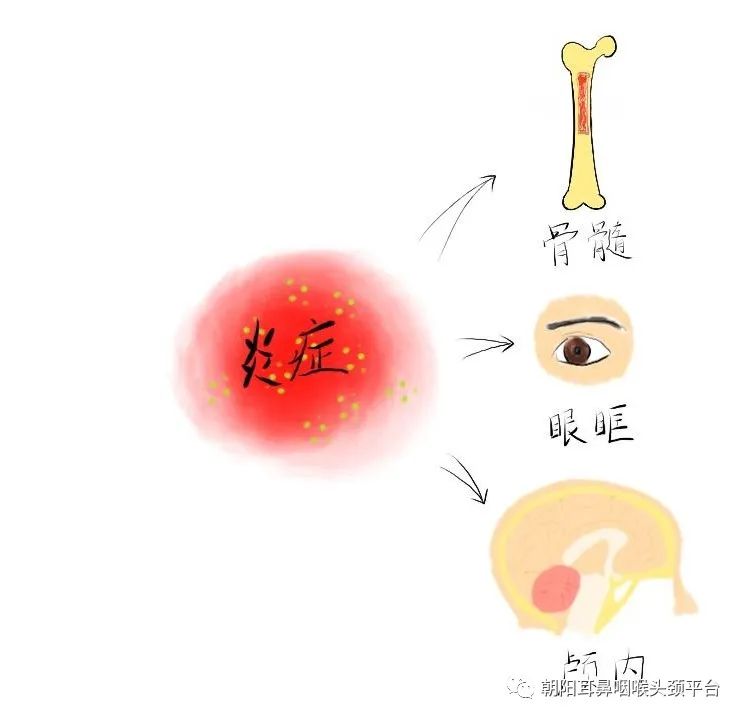 感冒引起鼻窦炎头痛,头痛急性鼻窦炎