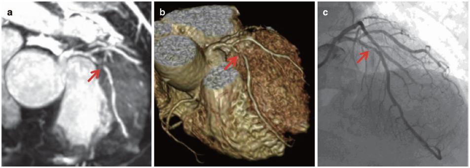 怎么看懂ct冠状动脉造影图片,冠状动脉造影图讲解