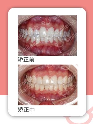 深拔牙齿矫正的潜在风险,隐形牙套的坑