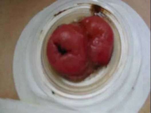 老人结肠癌晚期做了造口,76岁老人造口手术