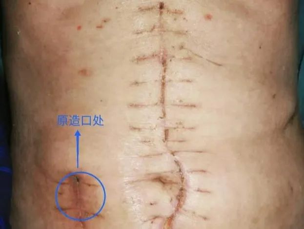 老人结肠癌晚期做了造口,76岁老人造口手术