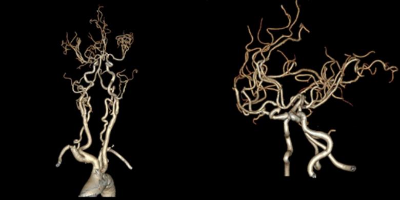 左侧大脑后动脉开窗畸形图片,脑部基底动脉开窗畸形如何治疗