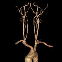 左侧大脑后动脉开窗畸形图片,脑部基底动脉开窗畸形如何治疗