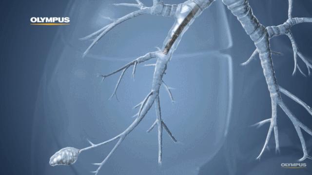 盘点医院各大科室侵入性检查：穿刺、内镜各显神通，小活检标本以“小”见“大”