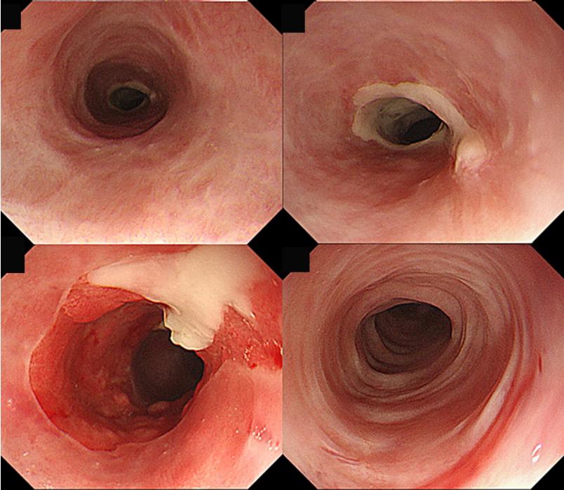esd术后食管狭窄扩张效果,esd曲安奈德