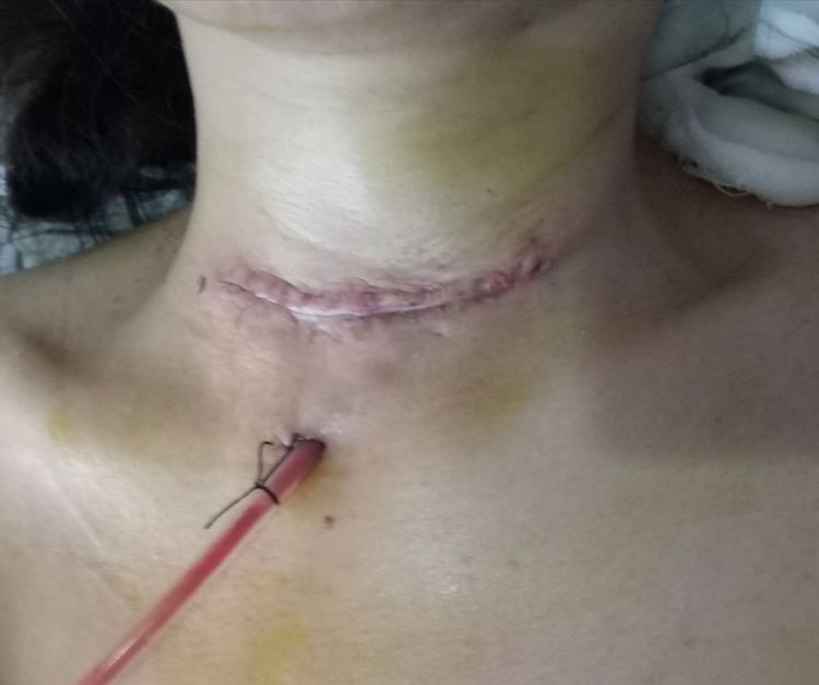 湖南省微创甲状腺切除医院,益阳市中心医院手术