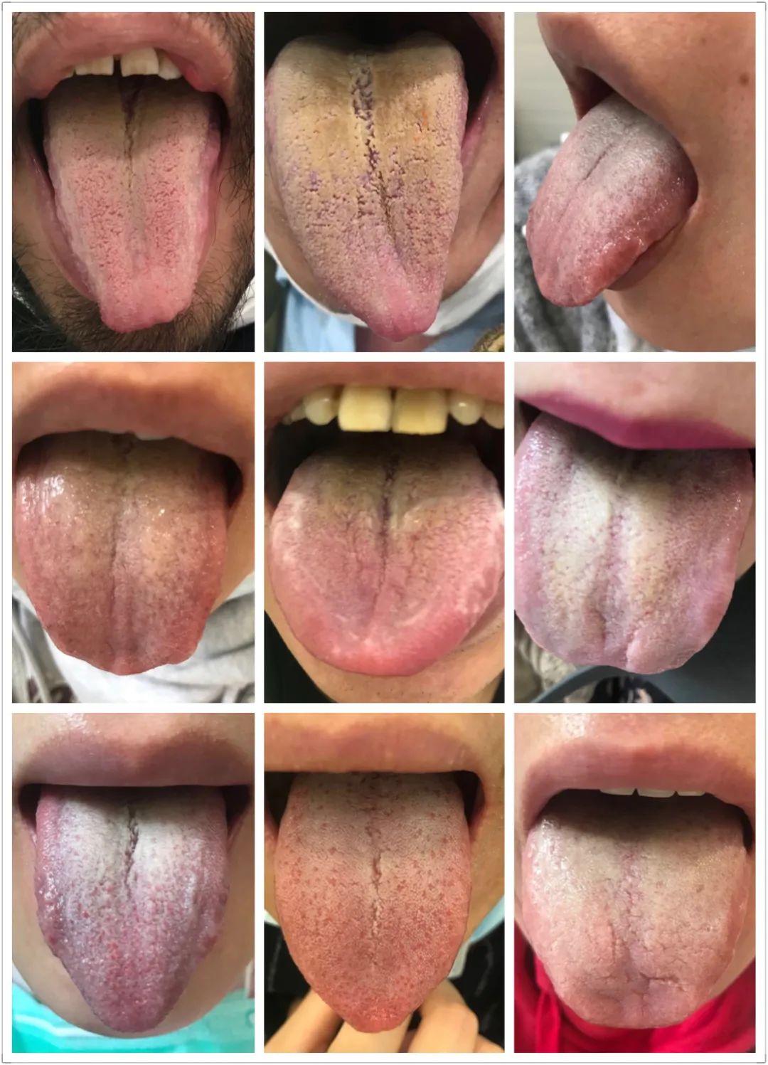 慢性湿疹止痒最有效泡脚的方法,湿疹患者可以每天用姜水泡脚吗