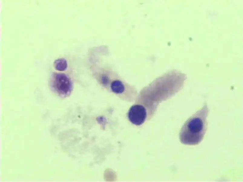 尿液中有肉眼可见杂质正常吗,尿液有形成分检查细菌偏高