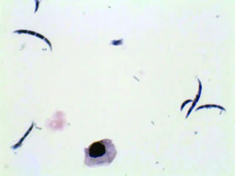 尿液有形成分检查,尿液中检测到的有形成分有哪些