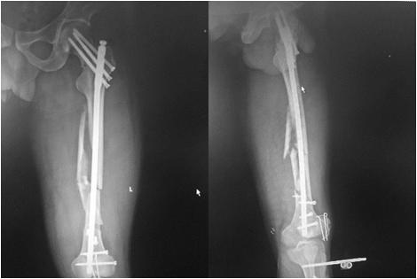 骨科微创手术动画,背部骨科微创手术