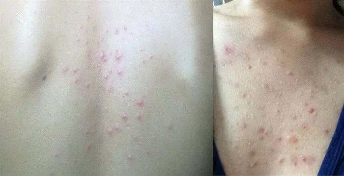 用什么洗脸抑制螨虫生长,用什么洗脸可以抑制螨虫生长