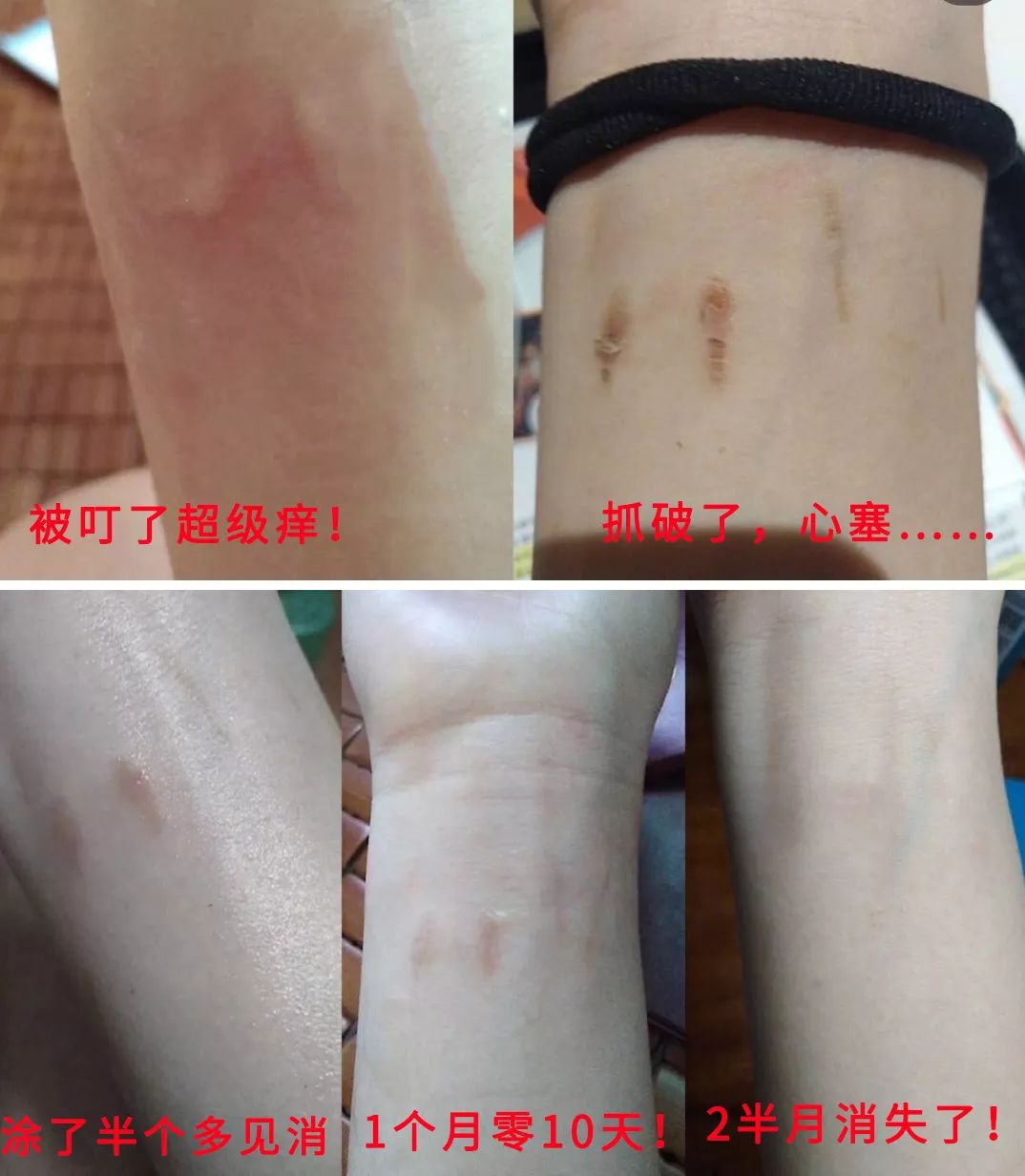 教你2分钟快速止痒,一小瓶止痒的药膏