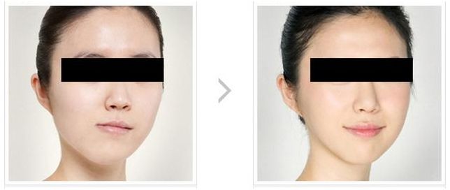 矫正牙齿的最佳年龄和价格表,孩子矫正牙齿多大年龄最合适