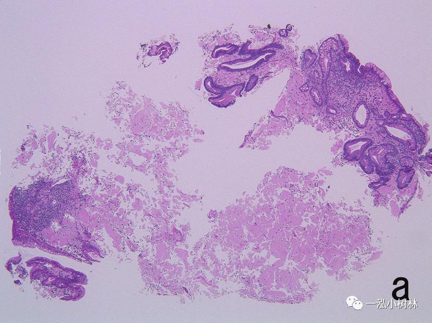 胃高级上皮内瘤变内镜案例,胃局灶性淀粉样变性预后