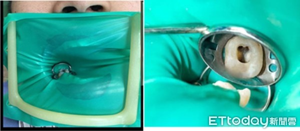 别以为抽过神经就没事？　１名女子牙齿根管细菌滋生而长牙包