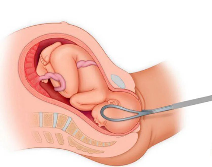 宝宝出生被产钳夹死,产钳夹出来的孩子后遗症有哪些