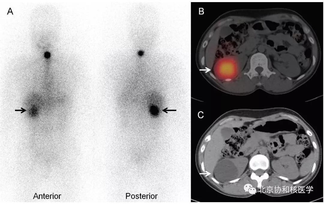 碘扫描最坏的结果,放射性核素扫描可以鉴别诊断吗