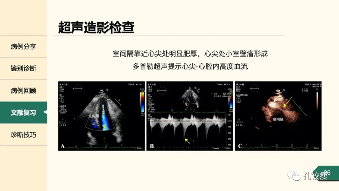 t波倒置在心电图中怎么看,T波低平心电图讲解