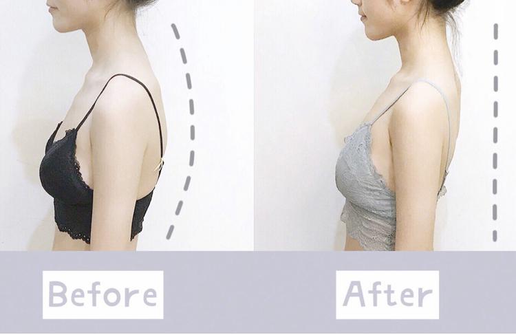 驼背平时自己注意可以改善吗,驼背如何矫正自己的气质