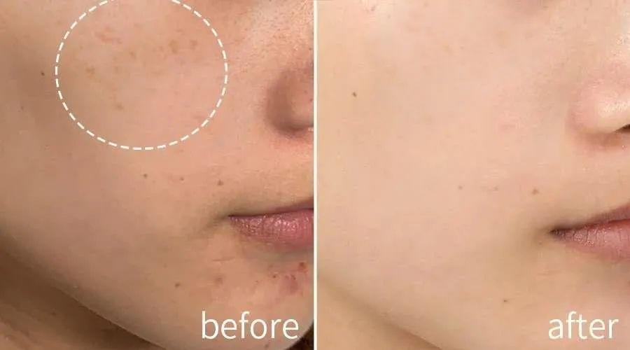 让脸上斑去掉,让脸上的皮肤变白