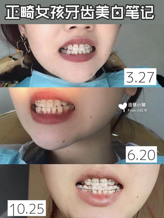 牙齿变黄你真的刷对了吗,牙齿黄了怎么办不用花钱去洗牙