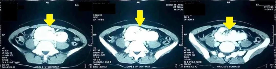 融合肾的胎儿能要吗,融合肾和异位肾哪个严重