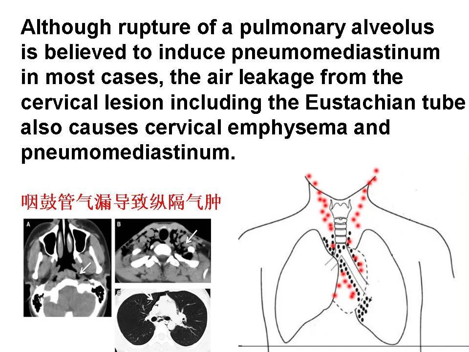 咽鼓管有积液能引起头胀头疼吗,咽鼓管堵塞导致鼓室积液