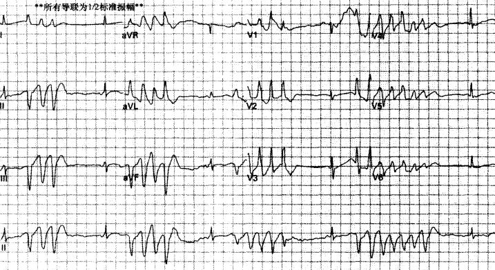 室速属于重大疾病吗,室速的相关资料