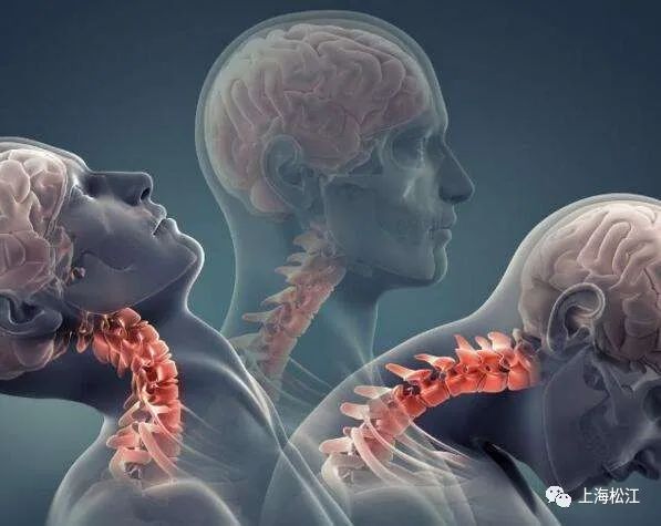 好的颈椎治疗枕头,神经根型颈椎病适合枕哪种枕头