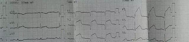 34岁北大博士心梗猝死,国世平老师突发心梗