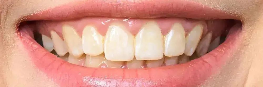 拿什么拯救你我的烂牙,拿什么拯救你的黄牙