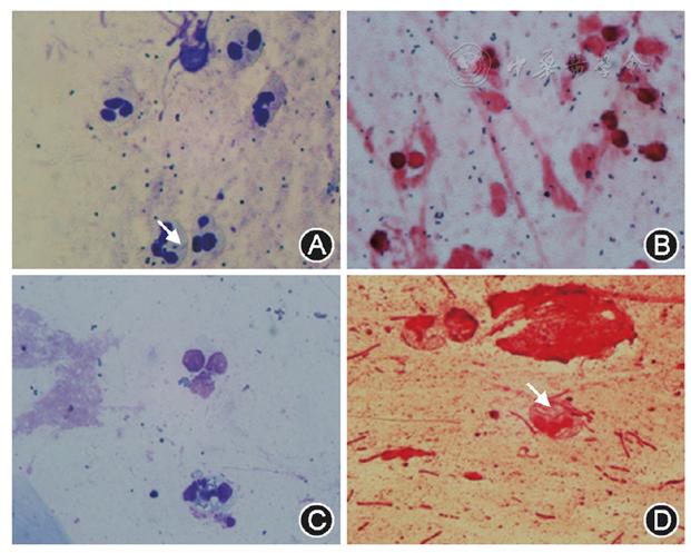 icu患者肺栓塞应急预案演练脚本,肺泡灌洗液标本标准