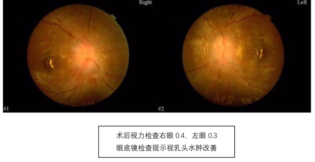 17岁女生头疼突然阶段性失明,19岁眼睛突然失明几分钟后恢复