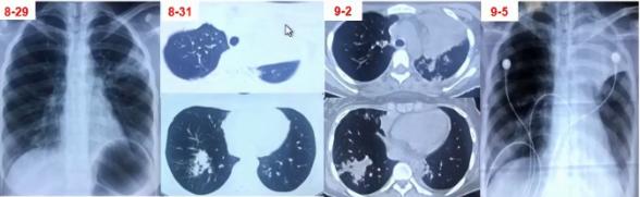 成人肺炎支原体肺炎诊治专家共识,2023肺炎支原体感染中药诊治指南