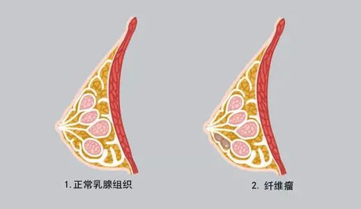 什么是乳腺纤维腺瘤,哺乳期乳腺纤维腺瘤