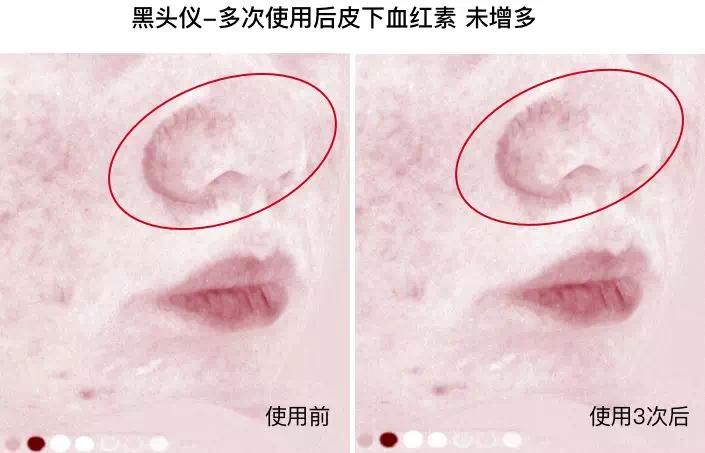 痘痘挤出黄水还是血水,痘痘挤出来的白色乳浆是什么