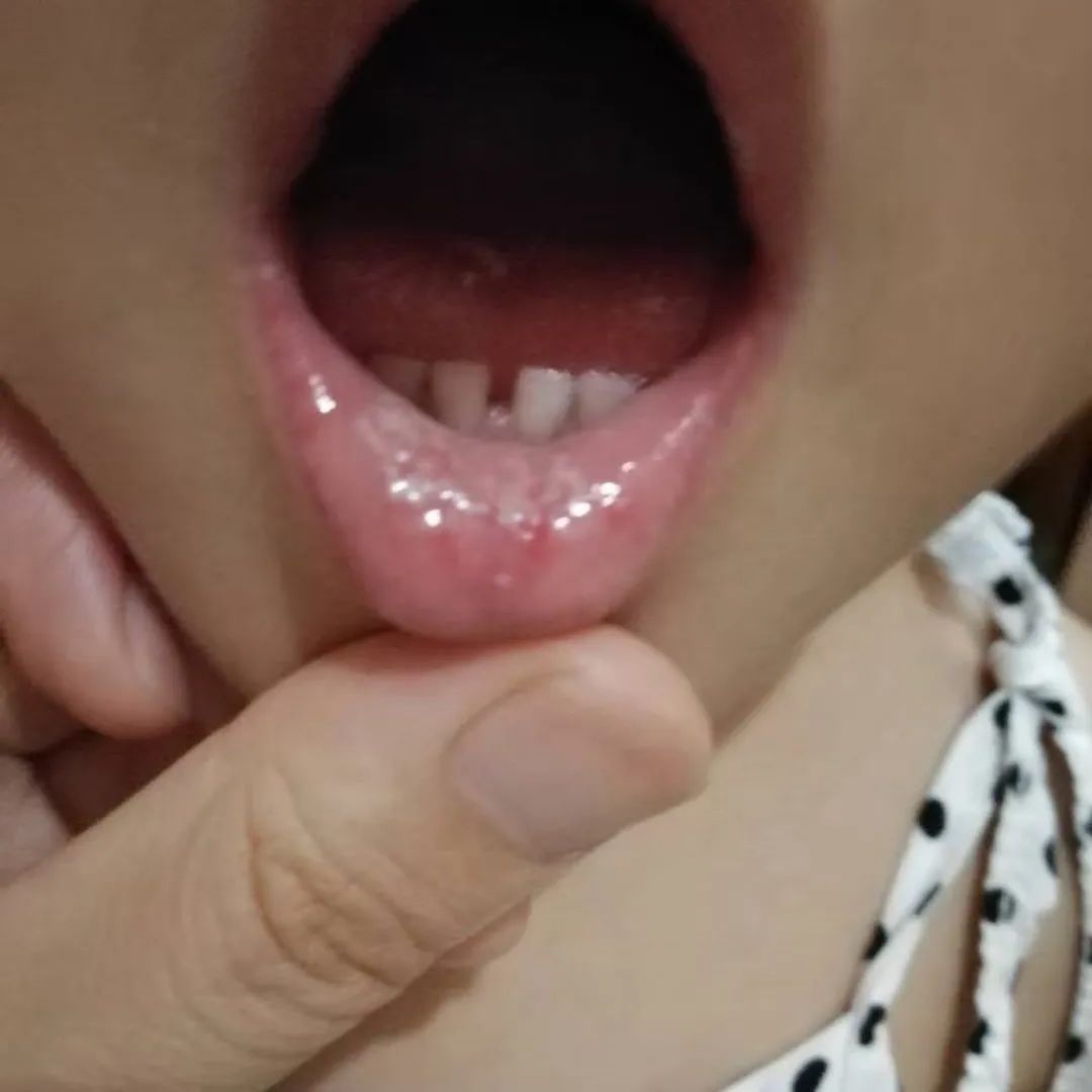 小孩嘴里长鹅口疮用什么药好得快,宝宝嘴里长了鹅口疮好不了怎么办