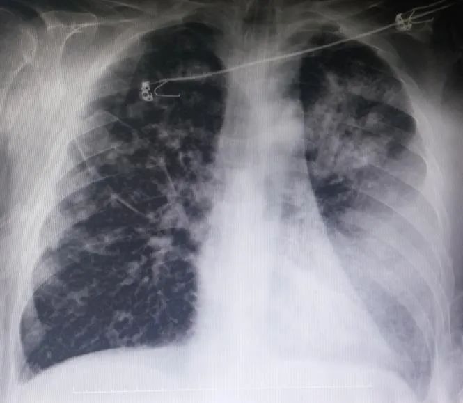 细菌性肺脓肿的主要感染途径,细菌性肺栓塞